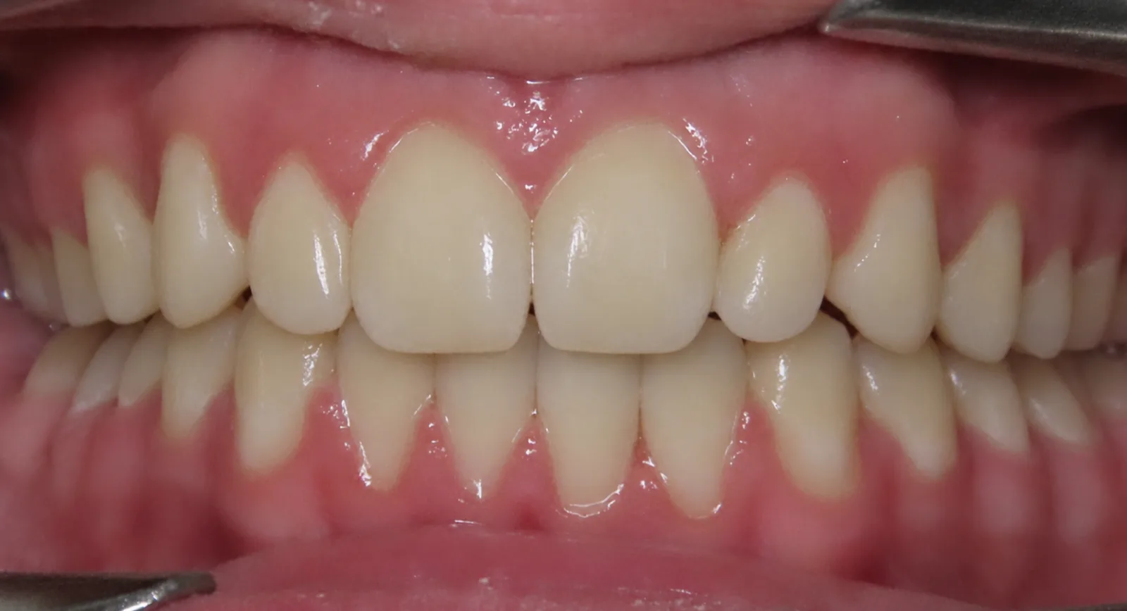 Front view of the same teeth after orthodontic treatment, Oasis Orthodontics case 01