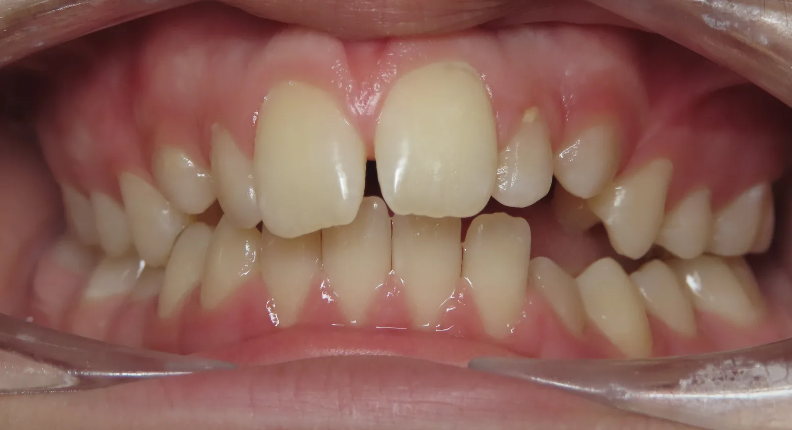 Front view of teeth before orthodontic treatment, Oasis Orthodontics case 01