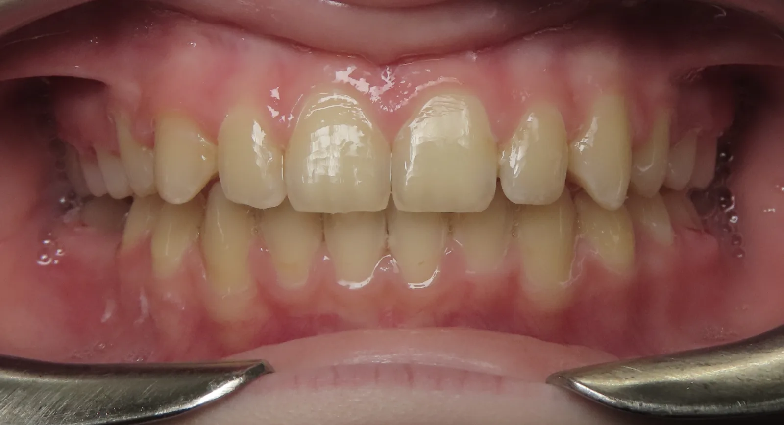 Front view of the same teeth after orthodontic treatment, Oasis Orthodontics case 02
