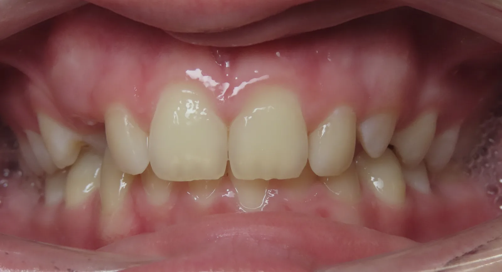 Front view of teeth before orthodontic treatment, Oasis Orthodontics case 02