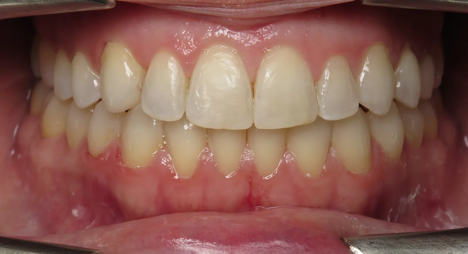 Front view of the same teeth after orthodontic treatment, Oasis Orthodontics case 03