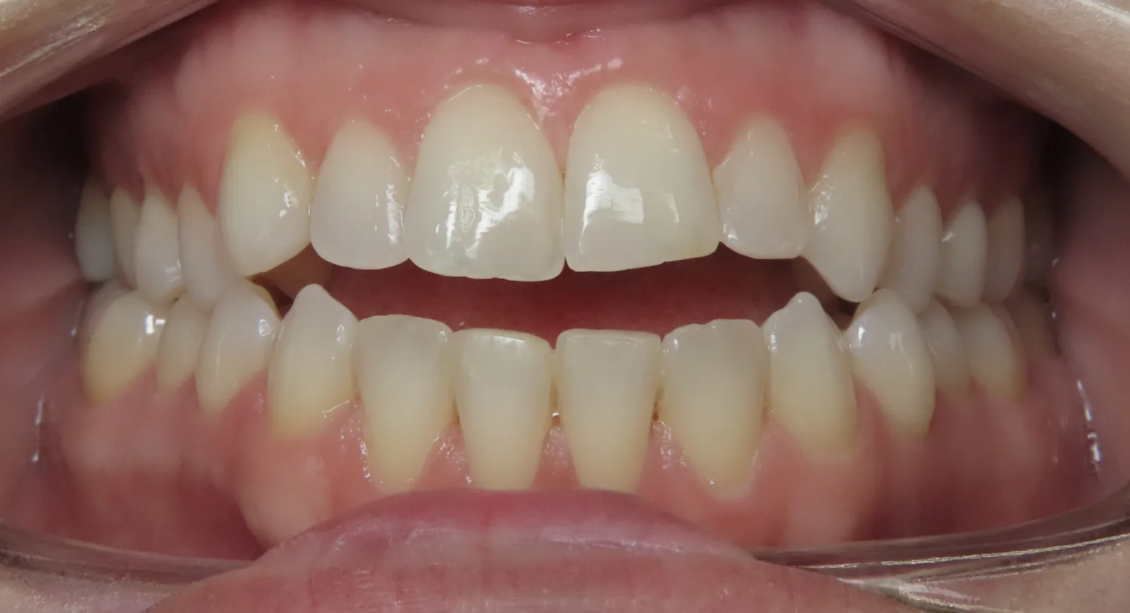 Front view of teeth before orthodontic treatment, Oasis Orthodontics case 03