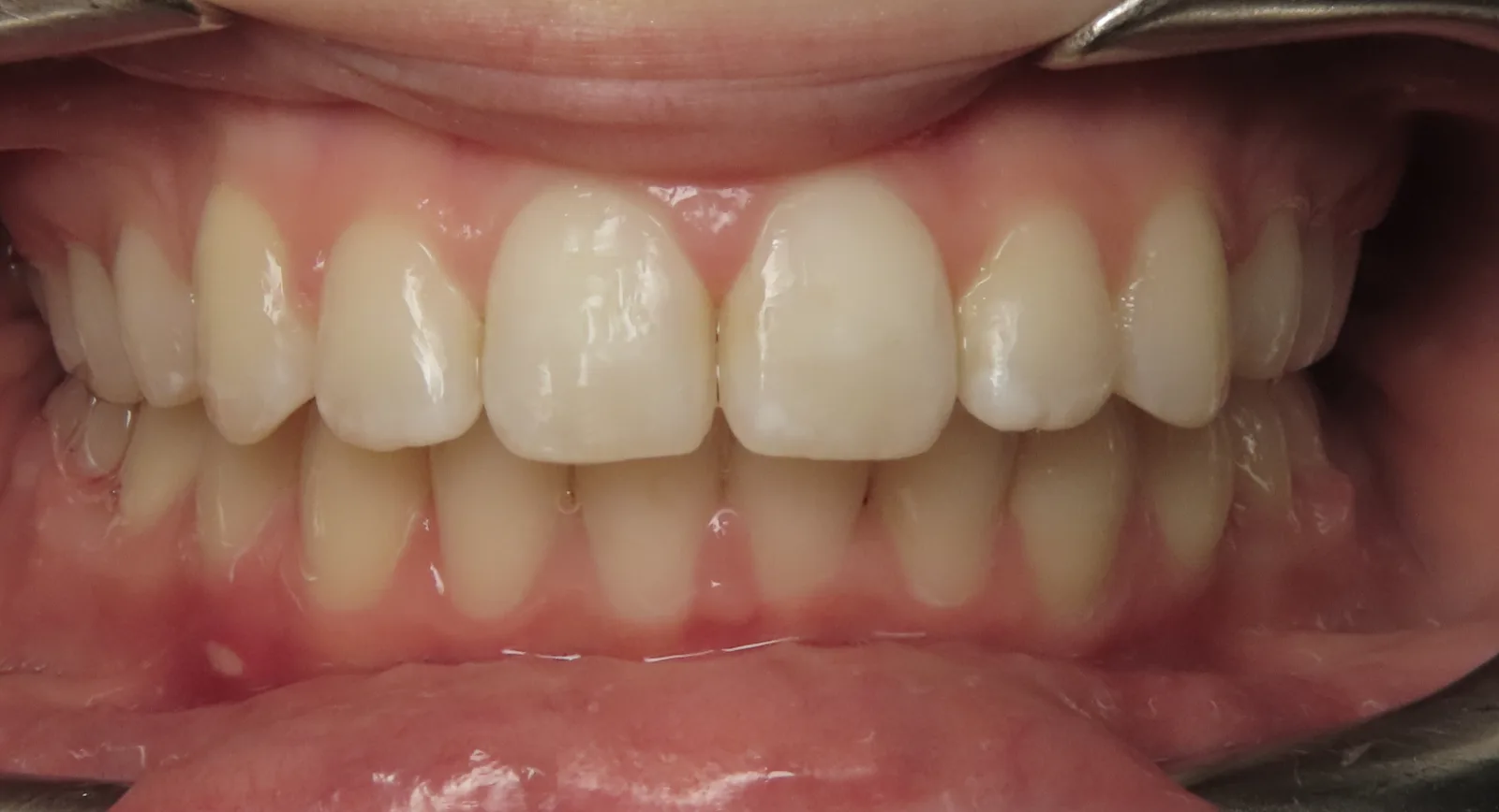 Front view of the same teeth after orthodontic treatment, Oasis Orthodontics case 04