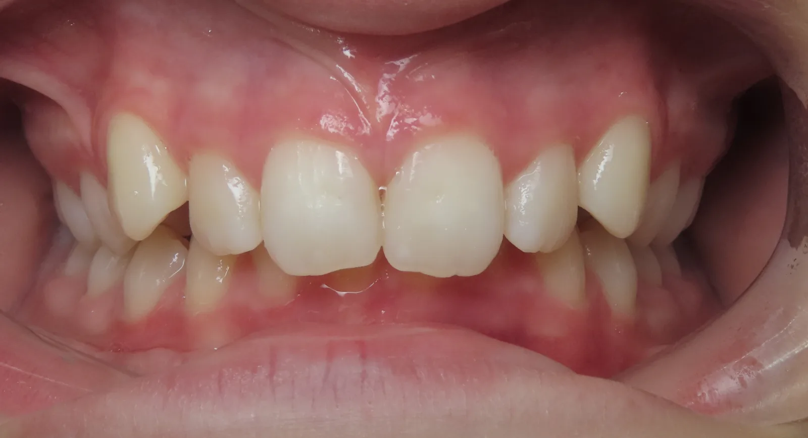 Front view of teeth before orthodontic treatment, Oasis Orthodontics case 04