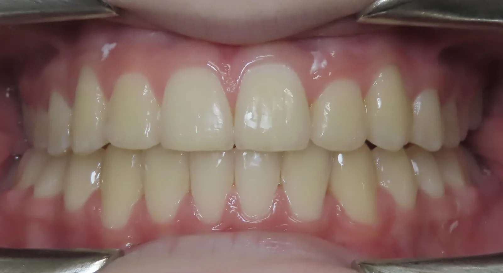 Front view of the same teeth after orthodontic treatment, Oasis Orthodontics case 05
