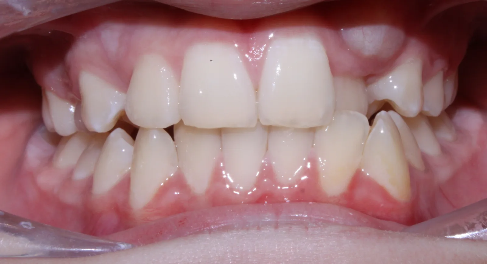 Front view of teeth before orthodontic treatment, Oasis Orthodontics case 05