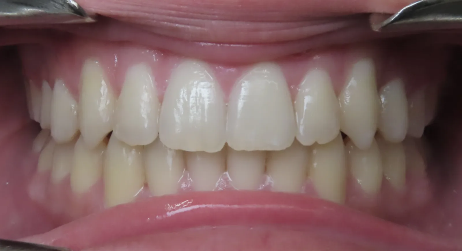 Front view of the same teeth after orthodontic treatment, Oasis Orthodontics case 06