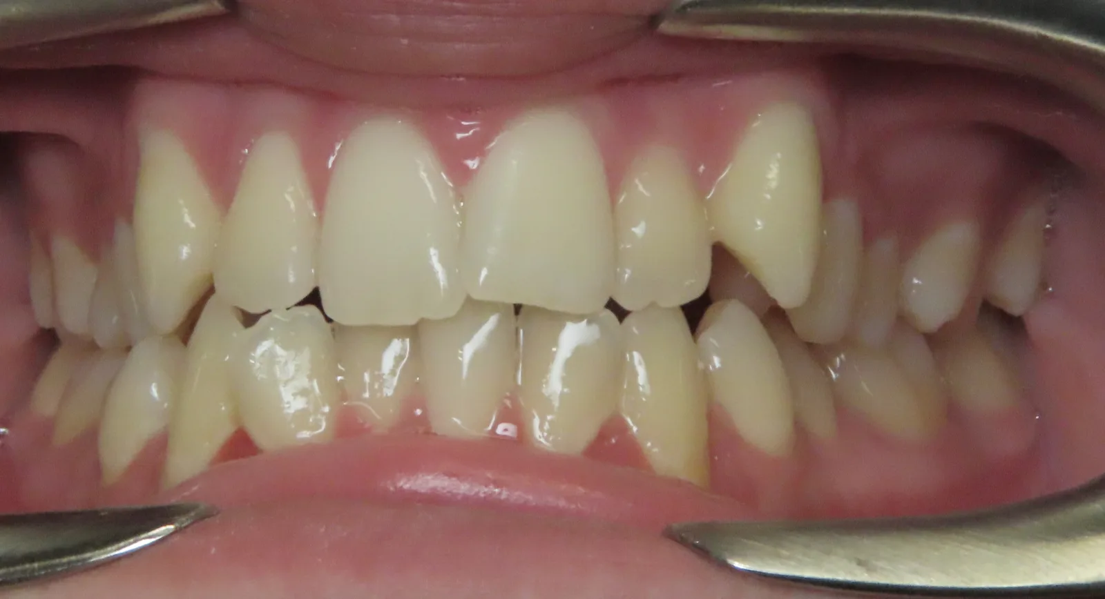 Front view of teeth before orthodontic treatment, Oasis Orthodontics case 06