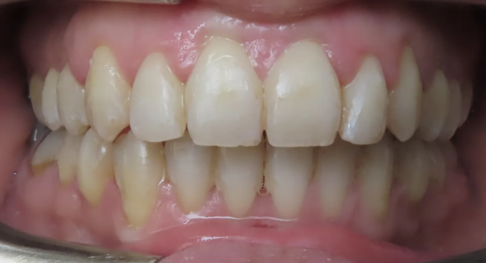 Front view of the same teeth after orthodontic treatment, Oasis Orthodontics case 07