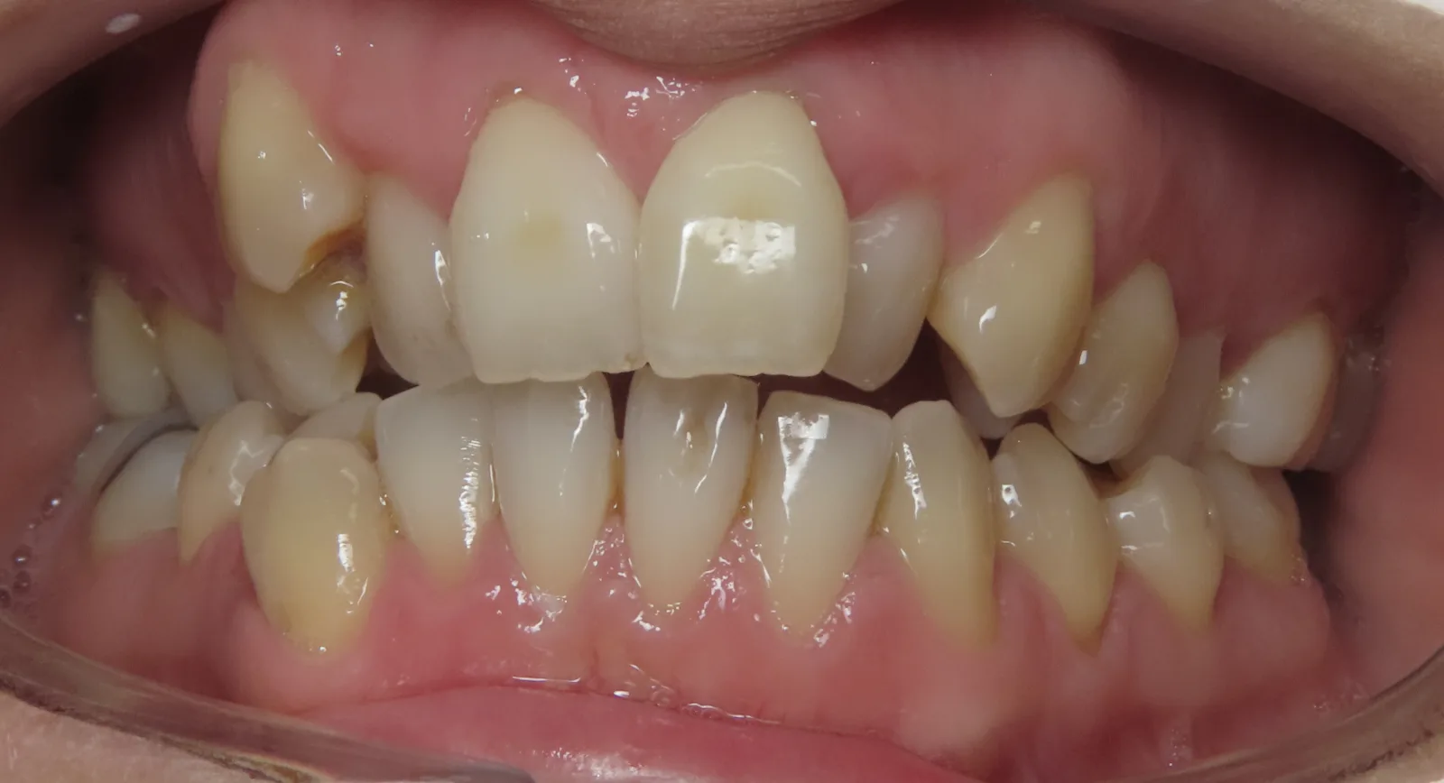 Front view of teeth before orthodontic treatment, Oasis Orthodontics case 07
