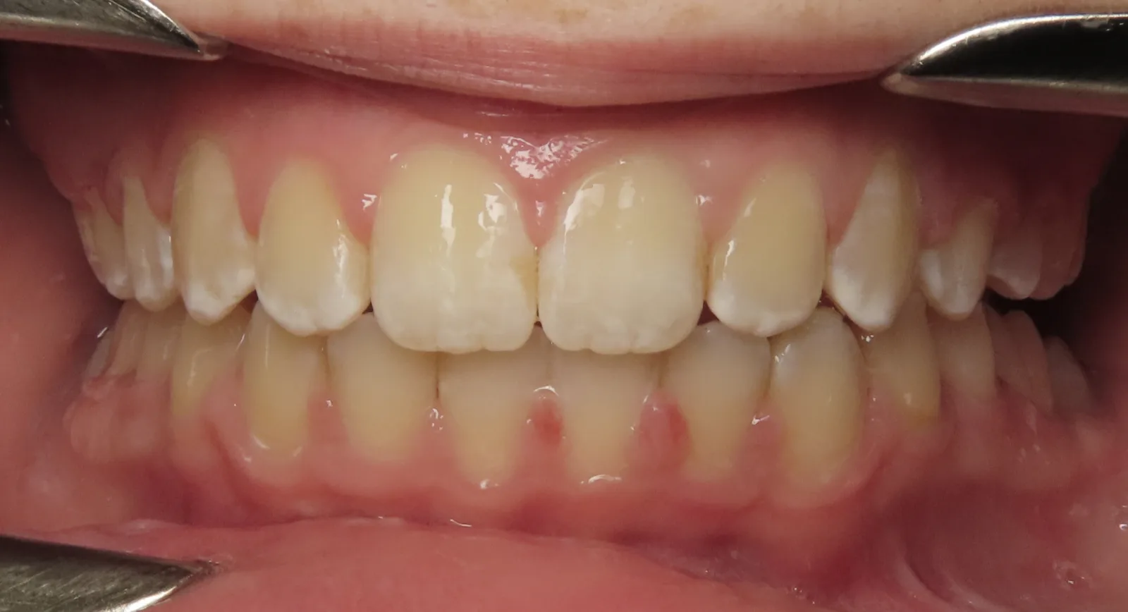 Front view of the same teeth after orthodontic treatment, Oasis Orthodontics case 08