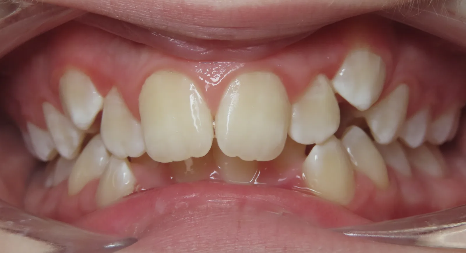 Front view of teeth before orthodontic treatment, Oasis Orthodontics case 08